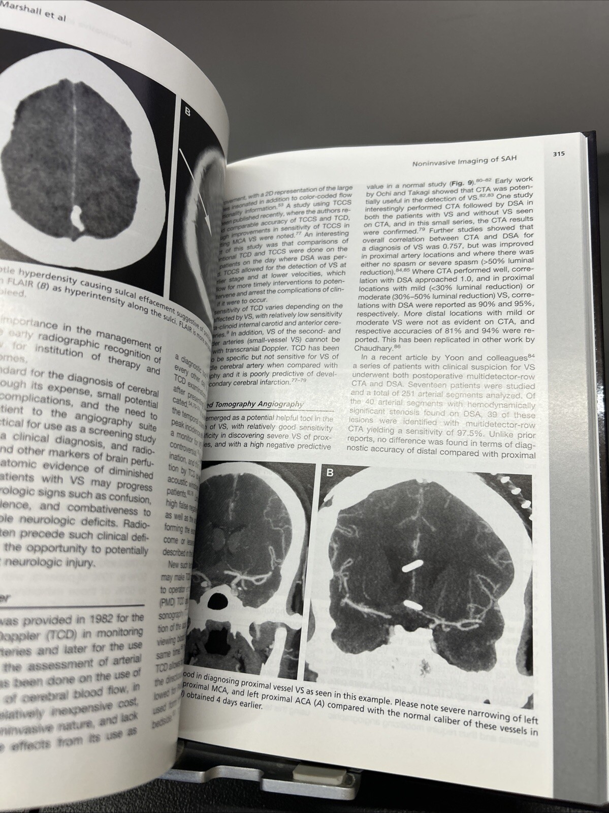 Neurosurgery Clinics Aneurysmal Subarachnoid Hemorrhage Apr 2010 vol. 21 #2