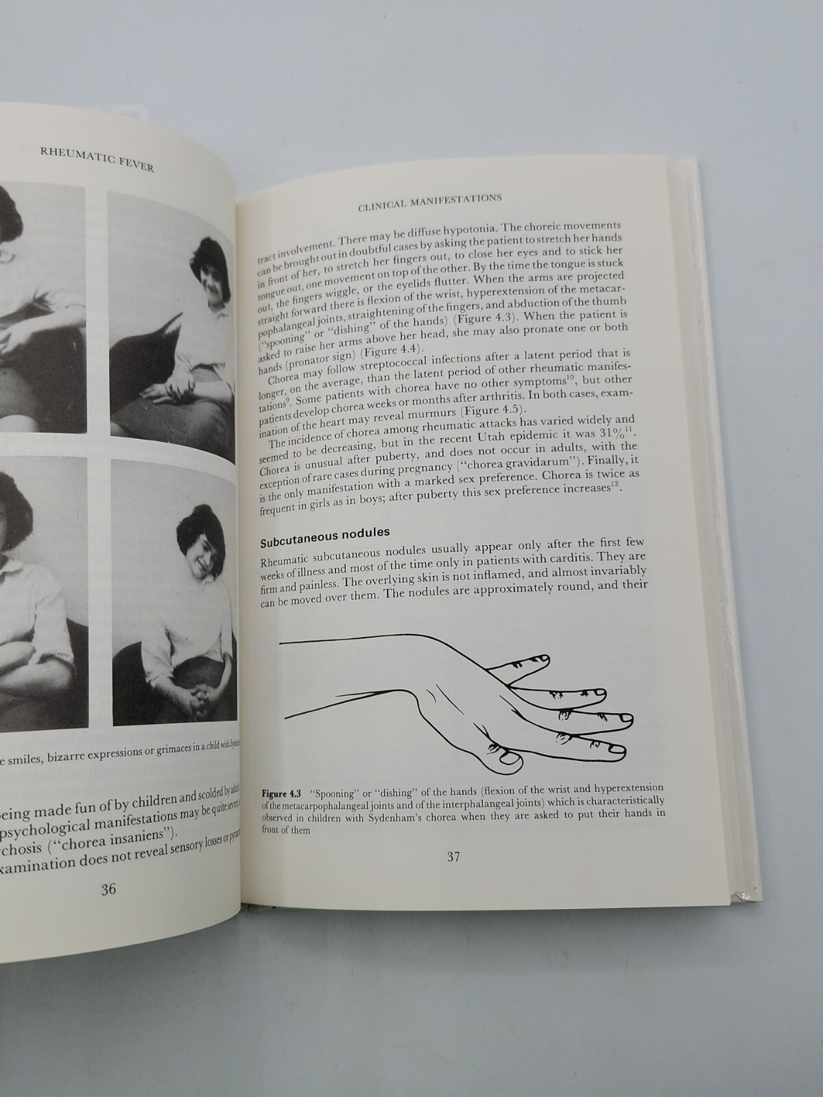 Rheumatic Fever 2nd Edition – Taranta & Markowitz – SIGNED / INSCRIBED 1989