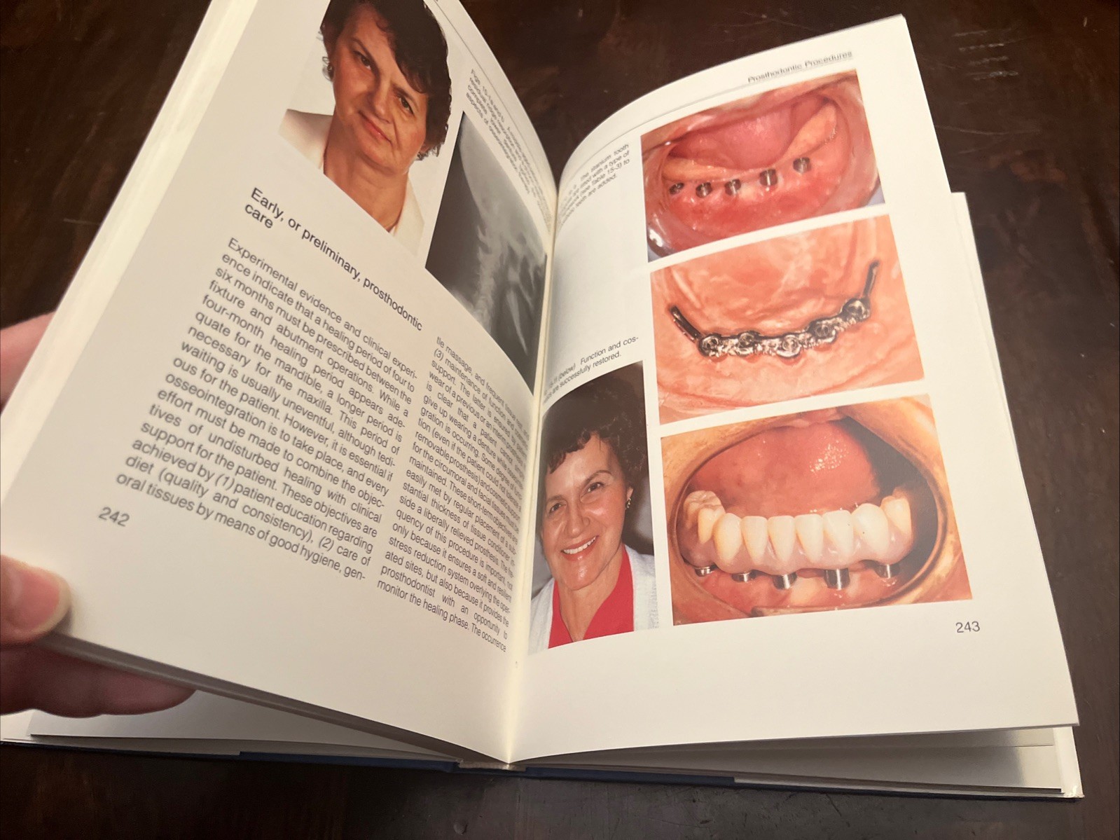Tissue-Integrated Prostheses Osseointegration In clinical dentistry, Illustrated