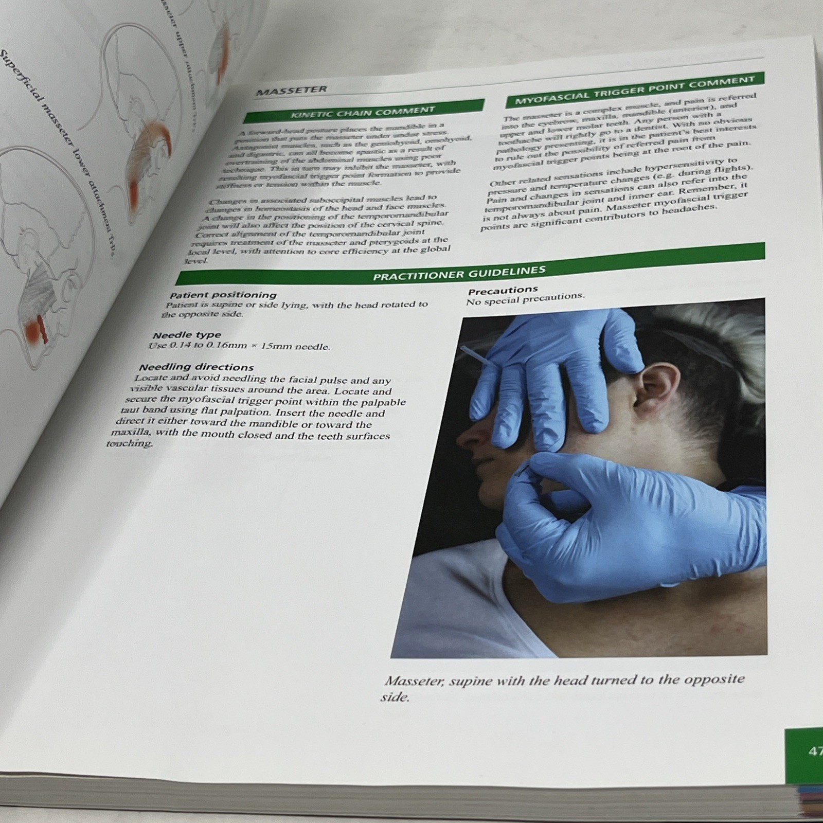Concise Book of Dry Needling : A Practitioner’s Guide to Myofascial Trigger…