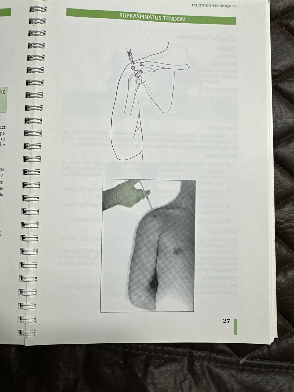 Injections in Orthopaedics and Sports Medicine by Saunders and Cameron (1997,…